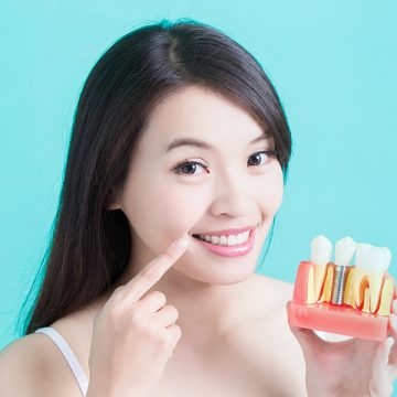 5 Reasons You Need Dental Implants