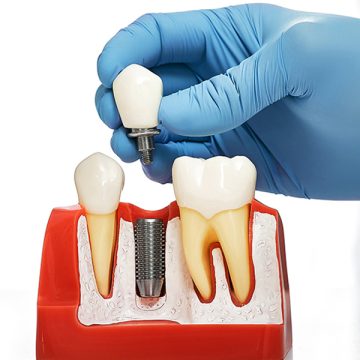 What to Expect When Getting a Dental Implant with a Crown